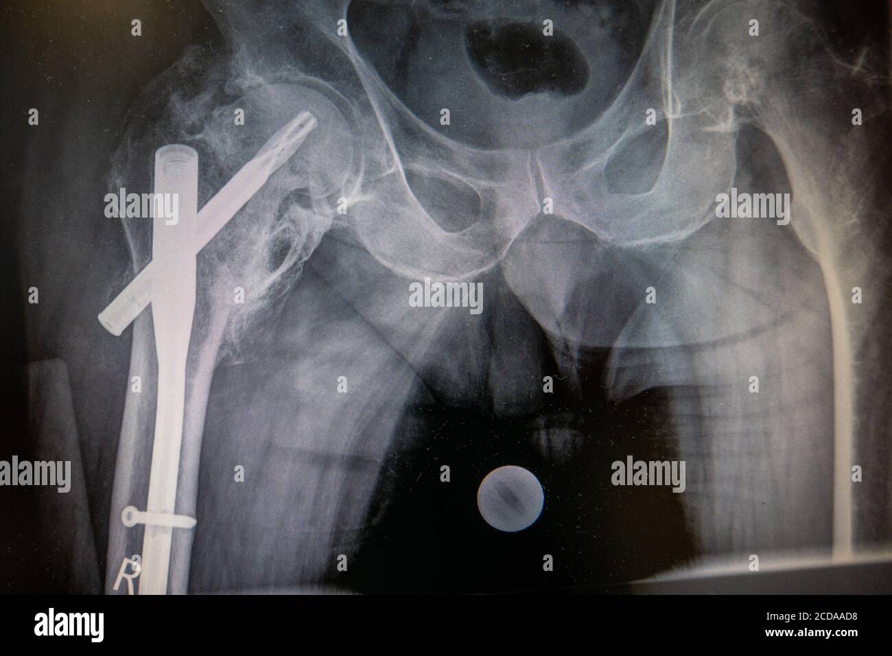 Raggi X di un'anca con un'unghia femorale impiantata Foto Stock