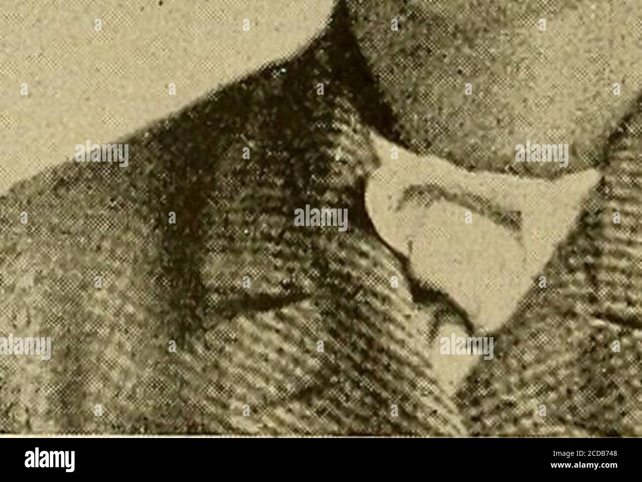 . Diagnosi fisica . Fichi, II e 12.-cretinismo. Russare, con raffreddori frequenti, un palato ad arco alto, e perapssssssssssssssssssssssssssssssssssss (E) negli agitatori paralisi, il volto simile a una maschera mostra quasi un cambiamento di espressione, qualunque cosa il paziente dica o faccia. Il collo di solito inclinato in avanti, e così rigido che quando il paziente desidera 12 DIAGNOSI FISICA di guardare a destra o a sinistra il suo intero corpo ruota come una statua su un pivot.in alcuni casi tremore è assente e le caratteristiche solo menzionedare poi di grande importanza nella diagnosi. (/) nella malattia di Graves (gozzo esoftalmico) lo lo è ammorso o lo è afflitto Foto Stock