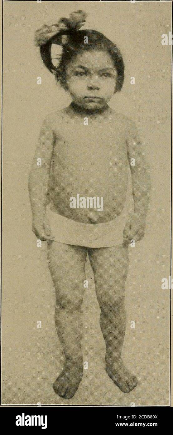 . Diagnosi fisica . Fichi, II e 12.-cretinismo. Russare, con raffreddori frequenti, un palato ad arco alto, e perapssssssssssssssssssssssssssssssssssss (E) negli agitatori paralisi, il volto simile a una maschera mostra quasi un cambiamento di espressione, qualunque cosa il paziente dica o faccia. Il collo di solito inclinato in avanti, e così rigido che quando il paziente desidera 12 DIAGNOSI FISICA di guardare a destra o a sinistra il suo intero corpo ruota come una statua su un pivot.in alcuni casi tremore è assente e le caratteristiche solo menzionedare poi di grande importanza nella diagnosi. (/) nella malattia di Graves (gozzo esoftalmico) lo lo è ammorso o lo è afflitto Foto Stock