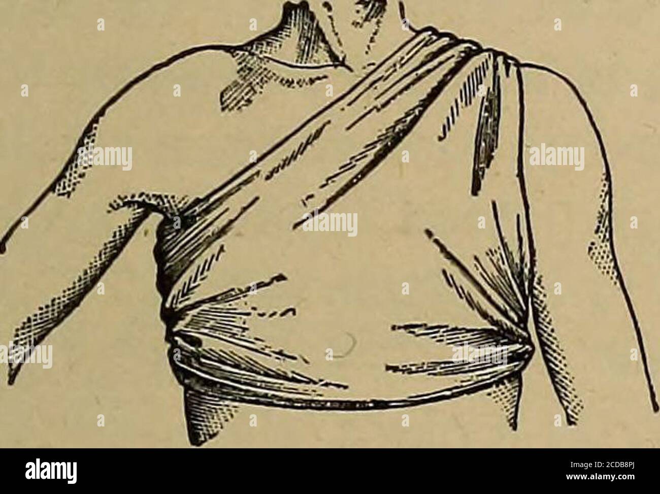 . Pronto soccorso per malattia e lesioni; . Fig. 71.-fascia triangolare applicata alla testa,da davanti.. Fig. 72.-bandaggio triangolare per il torace, vista frontale. Il torace e la schiena.- (1)applicare il triangolo (figg. 72e y^) con il suo centro al centro del petto e la punta sopra la spalla del lato interessato; (2) carrythe due estremità intorno al corpo e (3) legarli in un nodo della barriera Foto Stock