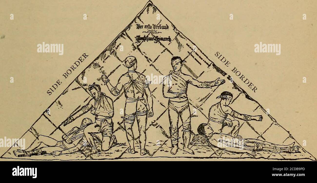 . Pronto soccorso per malattia e lesioni; . La mussola non sbiancata, di qualità moderatamente pesante, è il materiale di solito impiegato per bendaggi, anche se la varietà bleachedvariety, lino, formaggio-stoffa, cambrico, ed altri fabricipossono essere usati con piena soddisfazione. Flanella è spesso utilizzato dove si desidera calore con elasticità. Fig. 65. Il perno di sicurezza. IL BENDAGGIO TRIANGOLARE 93 mentre i bendaggi dovrebbero essere montati in modo pungente, attenzione dovrebbe betaken non tirarli così strettamente come costird l'arto.UN bendaggio tirato stretto può facilmente tagliare la supplicadel sangue le parti oltre esso e causare la gangrene o la morte Foto Stock