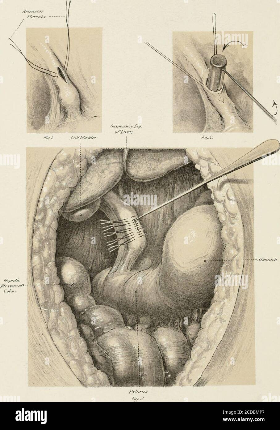 . Annuale e analitica ciclopedia di medicina pratica. Difficile enoughand suture del condotto normale è fuori della questione, dice uno. TT non vale la pena di esercitare grande attenzione nel cucire la fessura upa nel comune biliare-dotto, perché è quasi impossibile prevenire la perdita,e una piccola perdita aggiuntiva può fare noharm se uno scarico, dice un altro. Waituntil il dotto comune si dilata andispessisce prima di avventurarsi per aprirlo, ayall chirurghi. Halsted dichiara che ha certaeddalle operazioni sui cani e sull'uomo thatthe i normali biliari-dotti possono essere suturedeasily, precisamente, quasi infallibilly, ewithout d Foto Stock