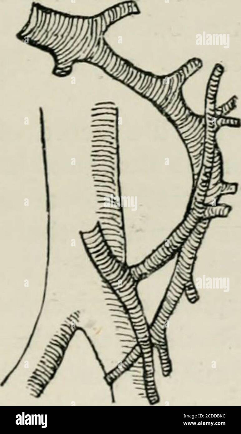 . Su ernia retro-peritoneale . ernia tro-peritoneale praticamente non esisteva. Fu lui a riconoscere che tali erniae si verificano in fossae che arenormale, ed è stato lui che ci ha dato per primo una descrizione intelligentdeli fossai e il loro probabile modo di origine.dice: Se in un corpo con un peritoneo normale si ha STORIA DEL FOSSM fino al grande omentum e al colon trasversale, e si spingerà verso destra la massa di piccoli intestini, sul lato sinistro della flessione duodeno-jejunale si assesterà una piega peri-tonea (Fig. 3). Questa piega varia in forma e size.Most frequentemente esso Foto Stock