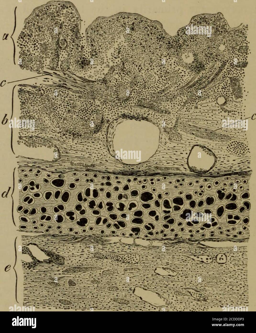 . Gli elementi dell'istologia patologica con particolare riferimento ai metodi pratici la ghiandola tiroidea può forzare il suo passaggio nella thelarynx e nella trachea in conseguenza dell'adesione della ghiandola a questi organi. Itenters la parete laterale fra le cartilagini e poi forma i piccoli nodi sotto-neat la membrana mucosa. 272 L'infiammazione croupe BRONCHI può essere causata sia dalla discesa del processo sameico dalla trachea, sia dall'estensione dell'essudazione croupous in un polmone pneumonico ai bronchi più piccoli. Vi è anche una cronicforma di croup bronchiale in cui le membrane croupe tubolari areforme Foto Stock