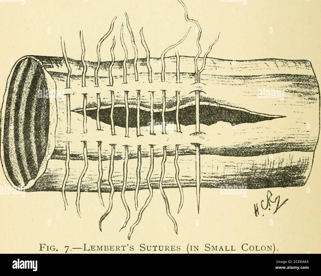 . Le coliche comuni del cavallo : le loro cause, sintomi, diagnosi, e trattamento. Und.incisione e sutura del Botvel.- finora ho aperto l'intestino al centro della fascia longitudinale, dove la parete appare più forte e più capace di sostenere suture (vedi Fig. 7, pag. 162). Con forbici a gomito appuntite, l'intestino può essere forato e la ferita si estende senza la minima difficoltà. La ferita è chiusa con suture di ritorcitoNo. I. esistono molti metodi per suturare le ferite intestinali, ma Lemberts è l'unico di cui ho esperienza. Suture applicate da Lemb Foto Stock