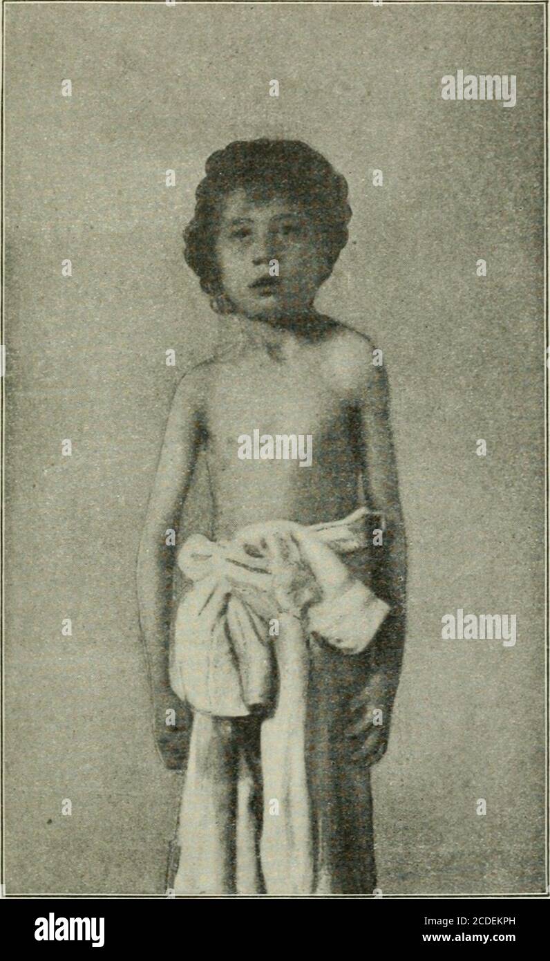 . Annals of surgery . e si pensava che fosse una pressureparalisi provocata in qualche modo al momento del parto. Il suo aspetto generale era quello di uno affetto da torticollis.The testa sembrava marcatamente disegnato a sinistra, e tentedmovement a destra mostrava i muscoli cervicali sul lato sinistro tobe molto accorciato e abbastanza teso. (Fig. i.) Dopo essere stato spogliato,la apparente rotazione laterale della testa è stata trovata dipendere dall'elevazione della spalla (Fig, 2), e questo a sua volta è stato osservato nuovamente per essere saldamente anchilosato alla spina dorsale. La condizionatadel bambino favoriva un molto Foto Stock