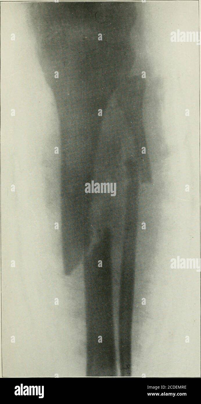 . Annals di chirurgia. Direzione con un frammento separato quadrato guidato nei tis-sues molli. La ferita è stata irrigata, coperta con garza bagnata di bicloruro, la gamba è stata posta in una scatola di frattura e ghiaccio applicato. Sedativi ad-ministered per sollievo di dolore intenso. Temperatura il 28 giugno, 99.2°F. Giugno 29, temperatura 102.6, morfina necessaria. Buona approssimazione impossibile a causa della comminuzione dell'osso, realimentazione della ferita pulita, irrigazione costante con soluzione di bicloruro 1:4000.l'immagine del raggio di Rontgen mostra lo spostamento laterale e i frammenti sciolti.(Fig. 4.) 2 luglio, sotto anestesia da etere una longitudine Foto Stock
