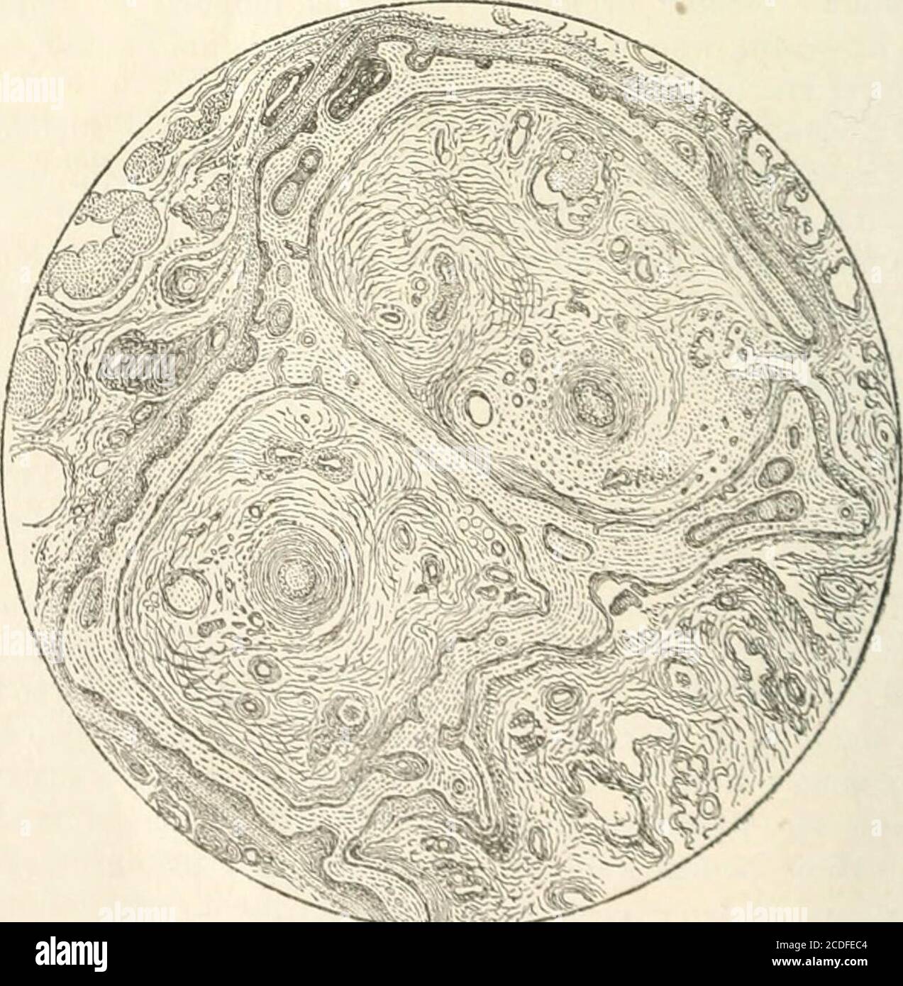 . Il Journal of laryngology and otology . Fig. I.degenerazione mucoide delle pareti di un seno venoso dal corpo turbinale inferiore, obj. J oc.c.. FiO. 2.una distensione, o cancellazione del corpo turbinale inferiore, obj. J oc.c. rinologia, otologia a7id. i 79 spazi mi permetto di suggerire che abbiamo un'interpretazione della morbidanatomia di questa malattia, perché le pareti che hanno gradualmente perso il loro potere di rinculo diventano di gradi sempre più distesi, eventuallyconducendo ad un ingrandimento morboso permanente dell'organo - in realtà, avarix. Si può esortare a che il processo degenerativo sia secondario Foto Stock
