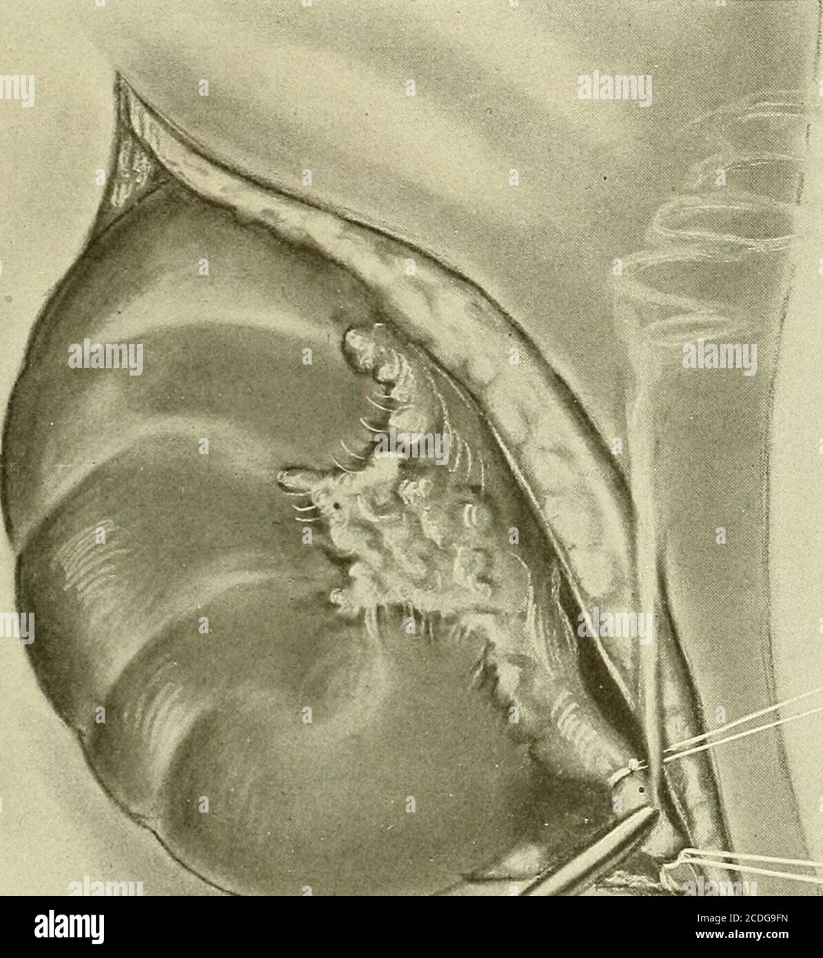 . Ginecologia : . Itao-WvhXtocue Uatvsvje.SA.^ SWi^% Fig. 468.-nefrectomia.esposizione della capsula grassa. OPERAZIONI SUL RENE 807 quando la capsula grassa è stata divisa, si può avvertire la superficie salda e liscia del rene. I morsetti sono messi sul grasso per tirare il rene su towardthe ferita e facilitare il punto seguente, che è separare la capsula grassa edistribuire il rene. La capsula viene staccata metodicamente dal dito, le superfici anteriore e postrior vengono liberate per prime con poca difficoltà. Nel liberare la capsula del polo superiore è normalmente più aderente, e se malattie infiammatorie Foto Stock