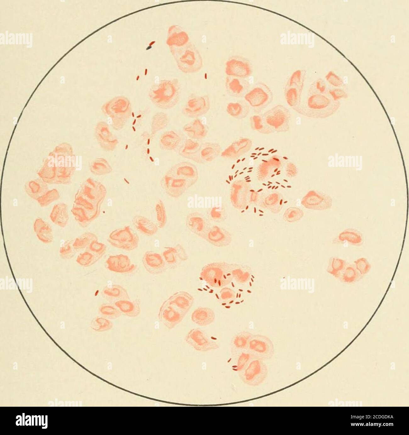 . Un trattato sulle malattie dell'occhio . onth. Le recidive sono molto adatte a verificarsi, e alla fine si verifica un recupero perfetto. In due casi osservati dal miglioramento del writercapide ha avuto luogo mantenendo il paziente nell'ospedale una dieta generosa e bagnando frequentemente gli occhi con una soluzione calda del 3 per cento di acido l)orico. Trattamento - Calomel (gr. ^q) dato internamente ogni quattro ore durante il giorno per un certo numero di giorni è benefico. Non è necessario alcun trattamento speciale diretto ai noduli. Una soluzione del bicloridedi mercurio (da 1 a 3000) può essere instillata ogni quattro ore, o qualche calomelma Foto Stock