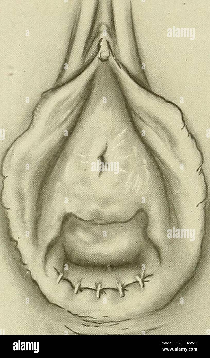 Ginecologia : . Nxl.^.G^ Fig. 295. - ingrandimento di un perineum stretto.  Taglio del tessuto cicatriziale mediante sezione sottocutanea con forbici.  Fig. 296.-ingrandimento di una ferita perineare stretta chiusa, lasciando  introito