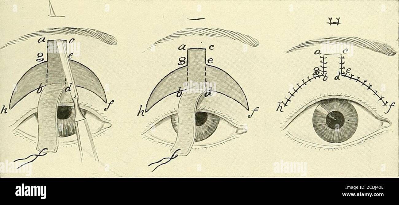 . La chirurgia, i suoi principi e la sua pratica . Fig. 480 e 481.-l'operazione Panas per Ptosi. Può essere compresa facendo riferimento alle figure allegate (figg. 480 e 481). In effetti, un'operazione disegnata da Tansley, che è una modifica di quella ideata da Hunt, e che viene eseguita come fol-lows: Due tagli perpendicolari e paralleli, A, B, C, D (Fig. 482), uno-. Fig. 482.-Tansley-Hunt Operation fob Ptosi congenita (Trans. Am Opz. SOC, 1895). Quarto di pollice di distanza, sono realizzati, e si estendono dal margine orbitale superiore all'interno di due linee del bordo superiore del coperchio. T Foto Stock
