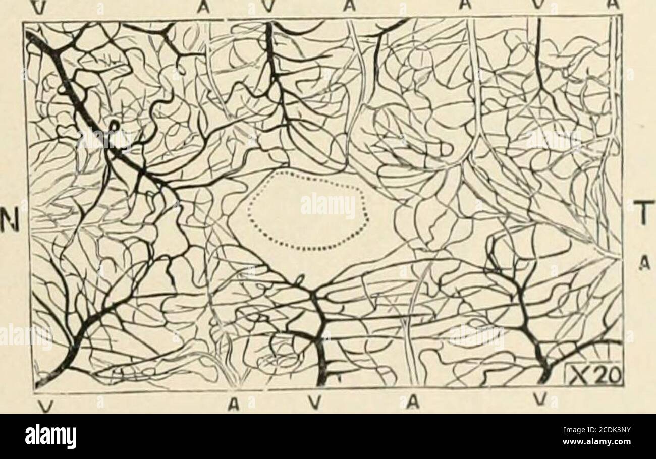 . Un trattato sulle malattie dell'occhio . Distribuzione dei vasi retinici. (Jaeger.)Fig. 46 A V A A V A. vasi sanguigni della retina umana nel punto giallo (iniezione artificiale). Lo spazio centrale corde-si)onds alla fovea centralis: Yl, arterie; V, vene; A^, lato nasale (verso il disco); T, lato temporale. Le maglie sono molte volte più larghe alla periferia della retina. (Nettleship.) spesso osservato nella retina vicino alla serrata ora. Queste sono apparse uponas manifestazioni atrofiche, e sono più frequentate nei retinneof adulti. Vascular Supply. (Alimentazione vascolare) – Artcriefi. (Strati anteriori della retina arenouris) Foto Stock