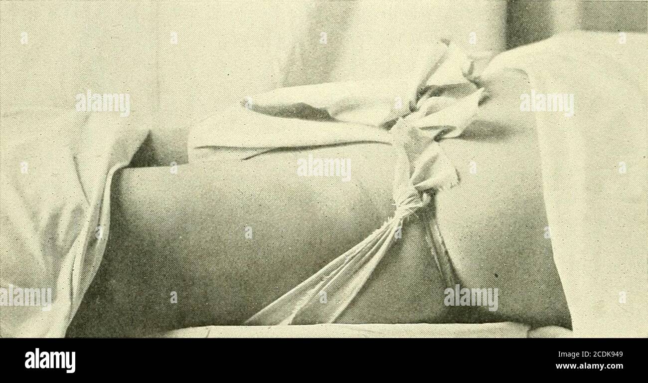 . Chirurgia, i suoi principi e pratica. Posto sotto 618 CHIRURGIA DELLO SCROTO, DEL TESTICOLO E DEL CAVO. Lo scroto. Le cinghie perineali sono portate intorno alle cosce efissate alla fascia intorno alla vita. Gli angoli lunghi del trio-angolo sono ora fissati al bendaggio della vita, e infine l'angleof centrale muslin è fissato al bendaggio della vita con un perno di sicurezza. Questo angolo centrale può essere sganciato quando il paziente desidera urinare, e può essere regolato da lui. Il bendaggio triangolare opportunamente regolato fornisce al paziente più comfort di qualsiasi altra forma di trattamento; infatti, Foto Stock