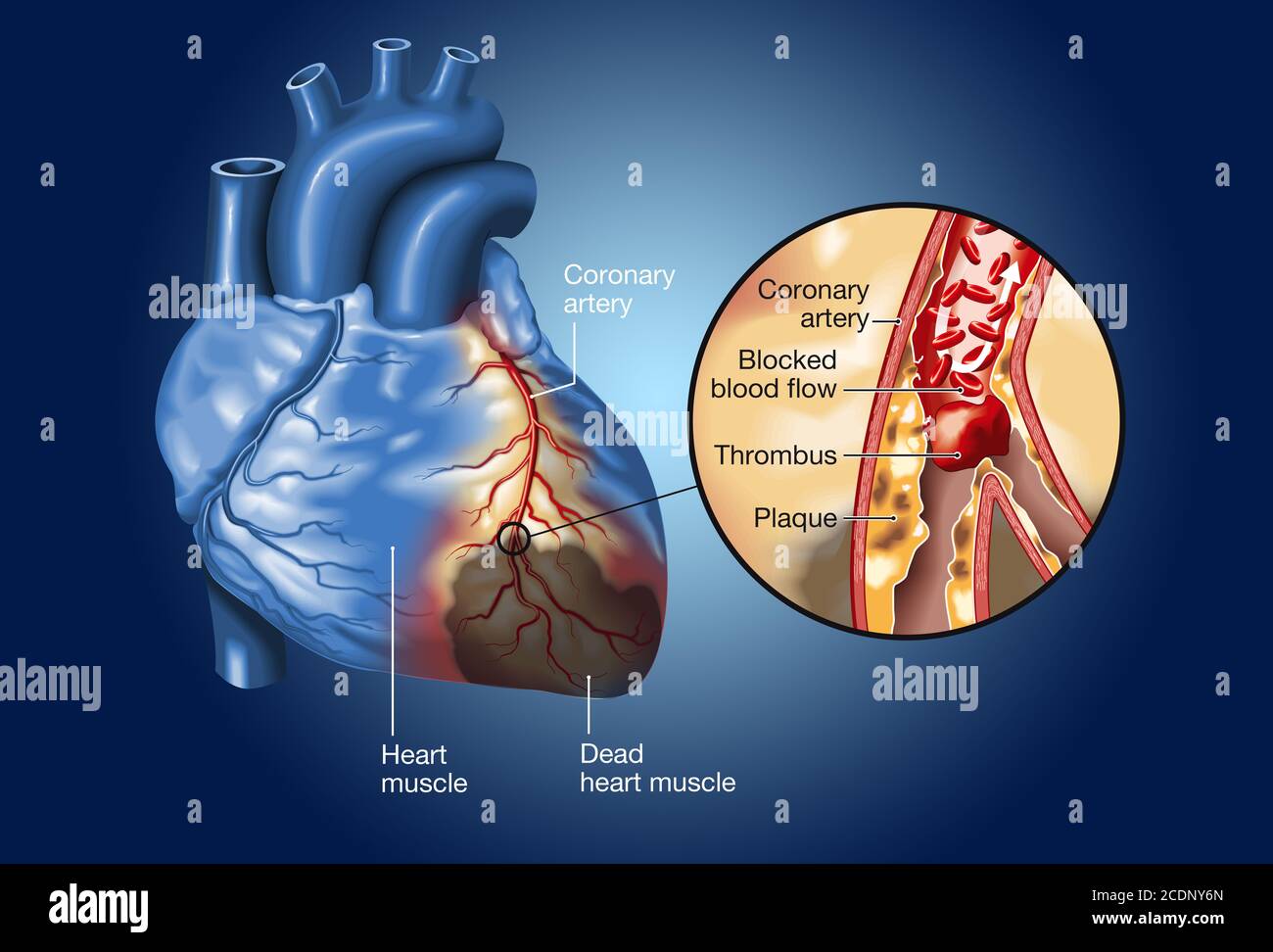 Placca nell'arteria coronaria, rottura del coagulo di sangue (trombo) e blocco del flusso sanguigno (infarto cardiaco) Foto Stock