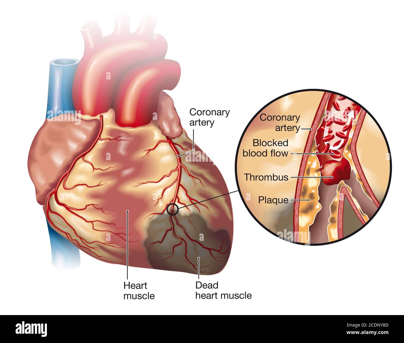 Illustrazione che mostra cuore sano (piccolo) e placca nell'arteria coronaria, coagulo di sangue (trombo) che si rompe e blocca il flusso sanguigno (infarto cardiaco Foto Stock