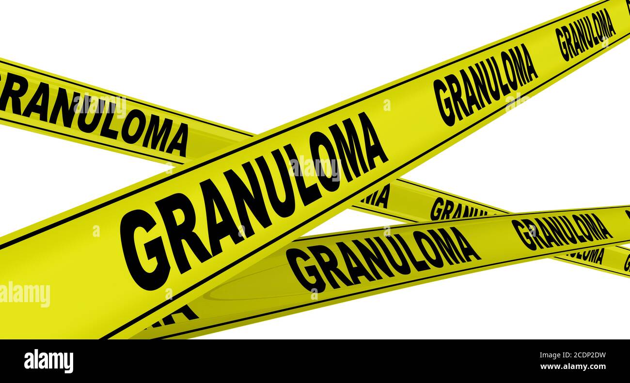 Granuloma. Nastri di avvertimento gialli con parole nere GRANULOMA (è una struttura formata durante l'infiammazione). Isolato. Illustrazione 3D Foto Stock