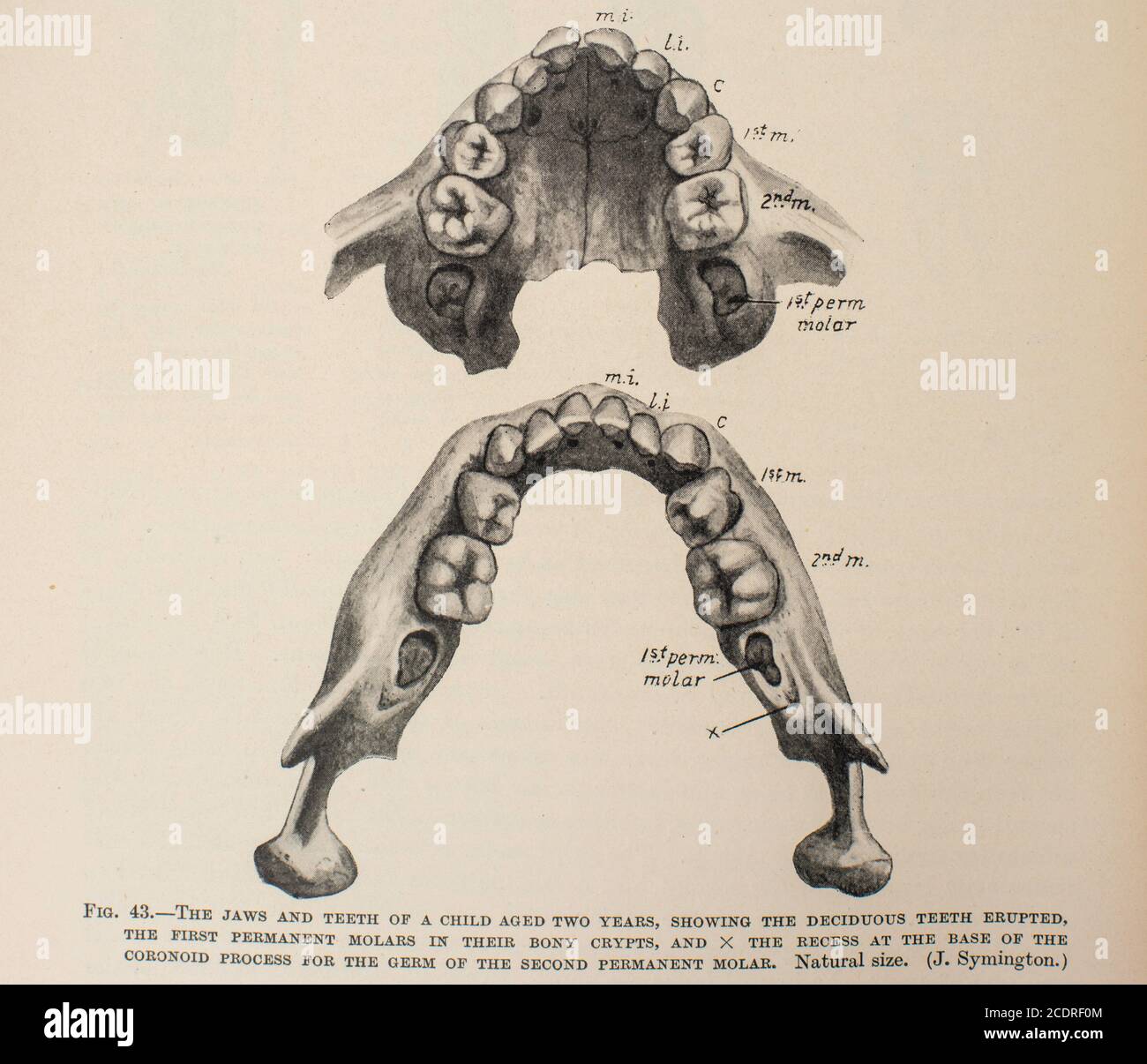 Quain's Elements of Anatomy col. III pubblicato nel 1896, un osso mandibolare del bambino. Foto Stock