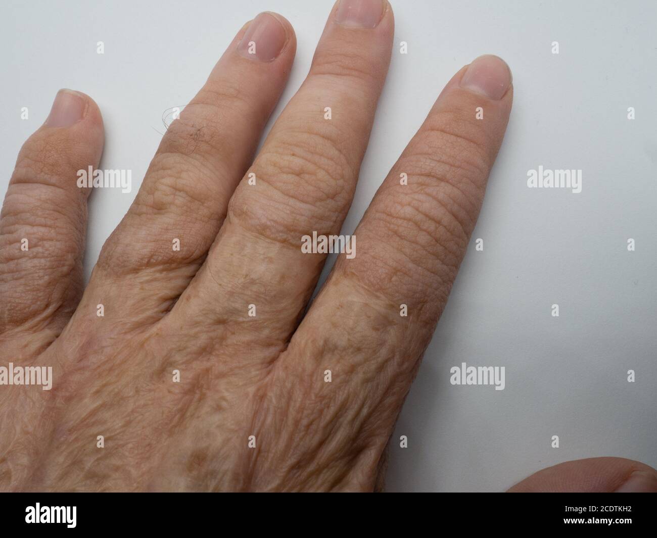 Cicatrice dell'innesto cutaneo immagini e fotografie stock ad alta risoluzione Alamy