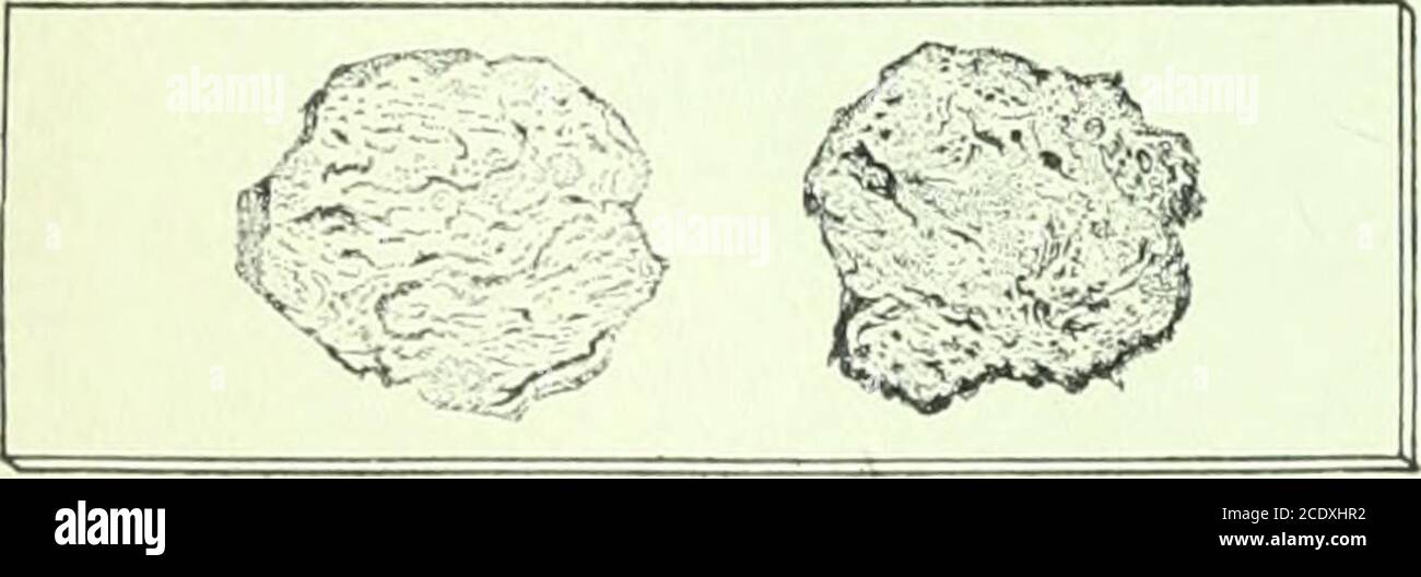 . Annals of surgery . sono impregnatedwith potassio-mercuric-iodide, come in Kalmerid Cat-gut, che permette loro di esercitare una battericidalaction locale nei tessuti. ???• sono tendini canguri genuini; sono iresmooth, diritto, di contorno uniforme e possessa resistenza alla trazione circa due volte quella del catgut. I tendini sono cromizzati, e in modo precuratelyis il processo regolato che ogni taglia mantaposizione in fascia o in tendine per approssimativamente trenta giorni.* i tendini di canguro di Kalmerid sono preparati in due gradi - boilable e non-boilable. Quest'ultimo è estremamente flessibile. Varietà e si Foto Stock