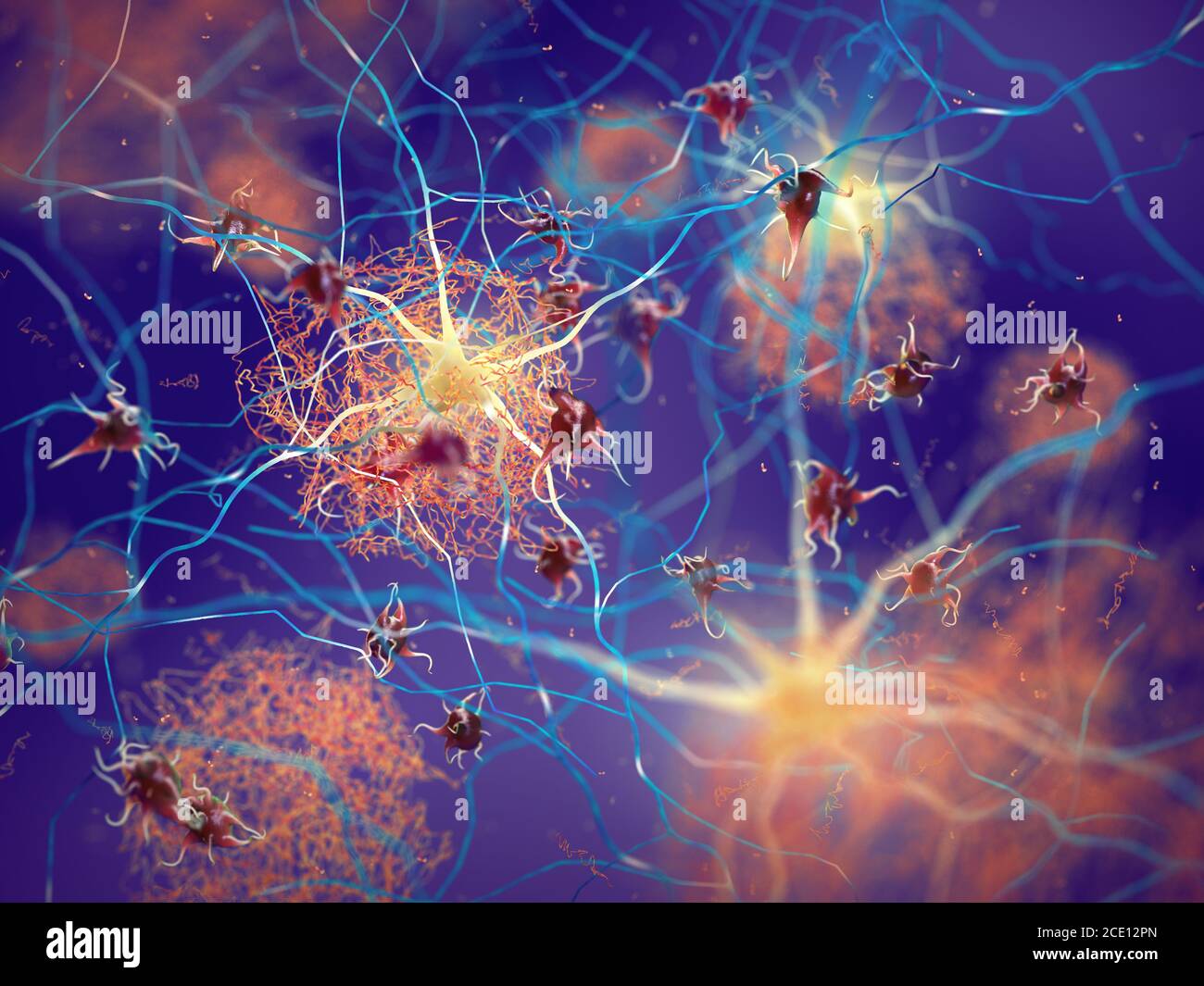 Placche amiloidi che si formano tra neuroni. Proteina beta-amiloide che disturba la funzione delle cellule nervose in un cervello con malattia di Alzheimer Foto Stock