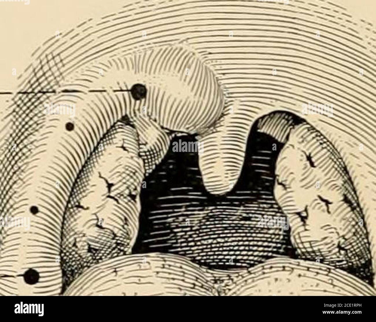 . Anestesia regionale : applicazione tecnica e clinica . Fig. 132.-blocco di campo per tonsillectomia: A e b sono i punti di ingresso del teneedolo ai poli della tonsilla. La colonna anteriore viene infiltrata dai due piccoli punti inter-mediati, e grazie alla resistenza offerta al fluido iniettato dalla farjTigealwall, la tonsilla si rigonfia facilitando così la sua enucleazione. A questo punto, l'ago deve essere fatto avanzare verso l'esterno (Fig. 133), occa-sionalmente il pilastro anteriore delle fauce perforate più lateralmente, soas per evitare di iniettare inutilmente la soluzione all'interno della ghiandola Foto Stock