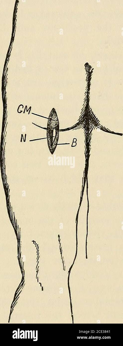 . Chirurgia operatoria, per studenti e praticanti. Arteria iatica e nervo granosciatico, che appaiono sotto la piriformis, e i vasi internalpudici e nervo. I vasi e i nervi pudici interni, che successivamente emergono dal bacino attraverso il grande forame sacro-sciatico, si curvano intorno al legamento sacro-sciatico minore, vicino all'ischio, e passano in avanti nella parte profonda del perineo. Stendendo il nervo sciatico: Il paziente giace sull'ab-domen con una sacca di sabbia sotto la parte inferiore del tronco. Un'incisione lunga tre pollici è fatta sulla parte posteriore della coscia, l'estremità superiore del in Foto Stock