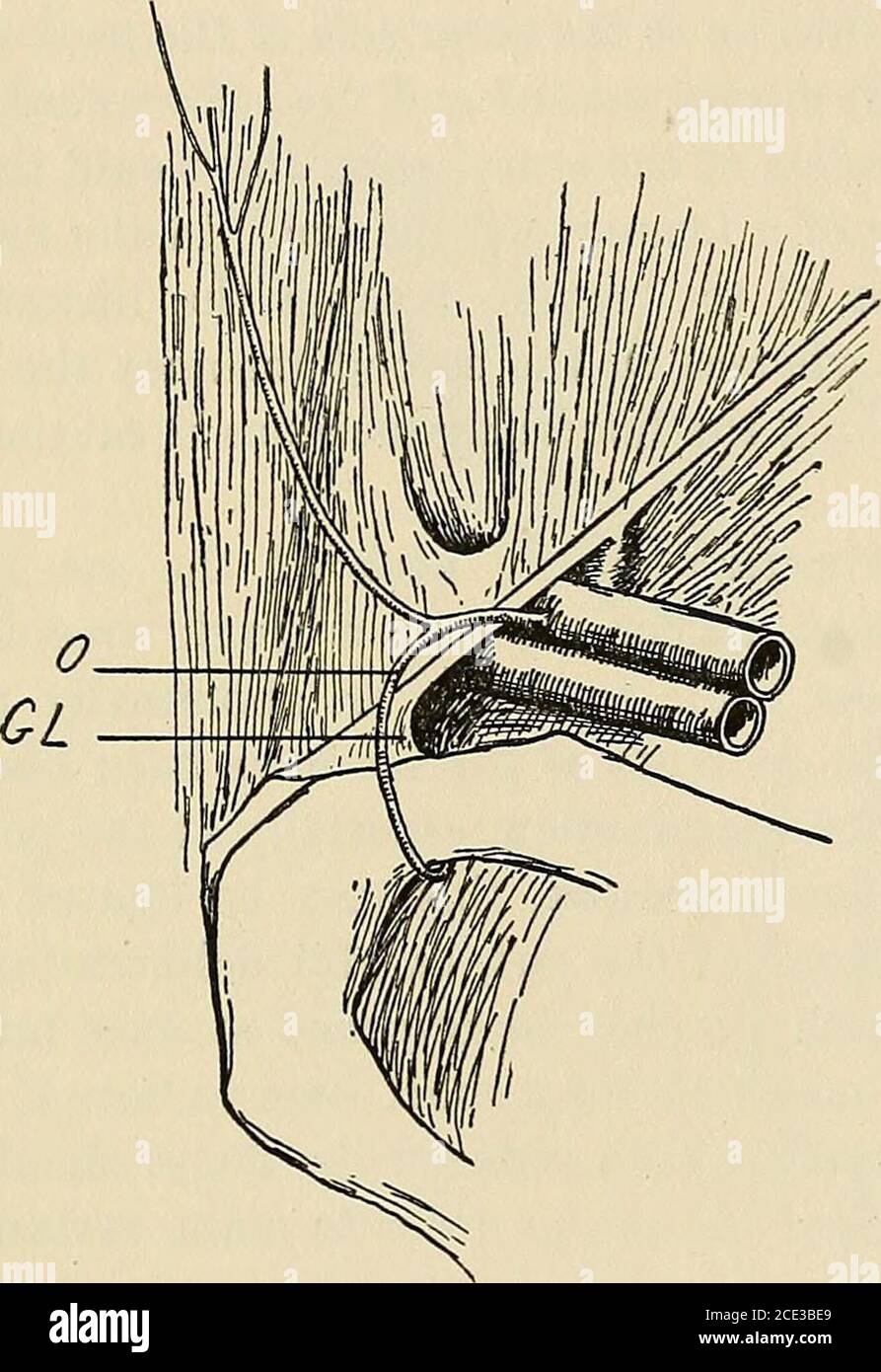 . Chirurgia operatoria, per studenti e professionisti. Varia; possono consistere di intestino, grande o piccolo;di omentum, o di entrambi; e occasionalmente ci possono essere altri organi, come la vescica, l'ovaio, ecc. dopo che il sacco è stato libero-aperto, il suo contenuto dovrebbe essere esaminato. Qualsiasi fascia di costrizione nel corpo del sacco dovrebbe essere diviso, e un tentativo poi fatto topull l'intestino giù in modo da facilitarlo al punto di costrizione; butin questo sforzo molta forza non dovrebbe essere usata. Uno sforzo è fatto alle OPERAZIONI PER L'ERNIA. 441 inserire il dito nel collo del sacco e, se ciò ha esito positivo, Foto Stock