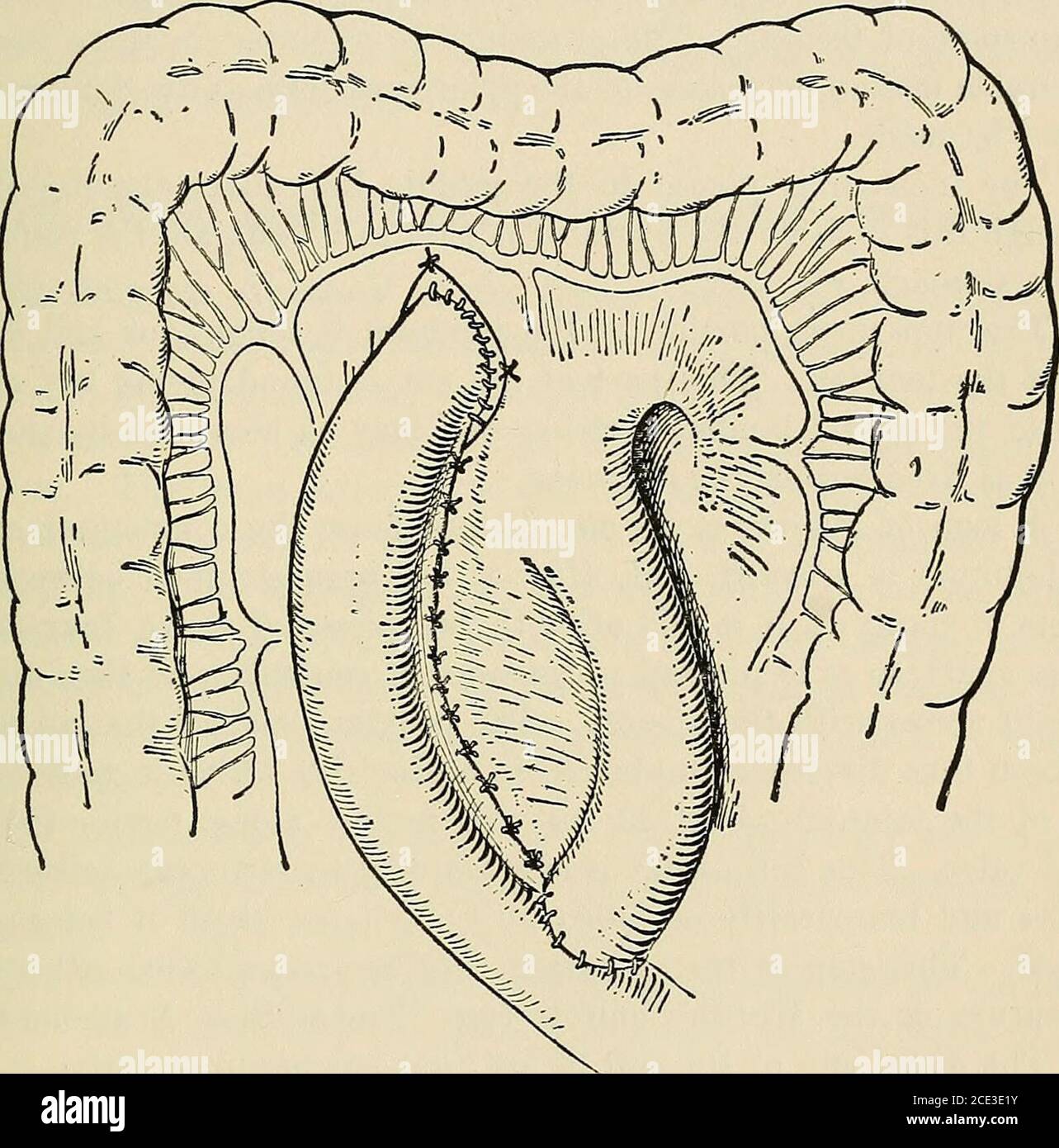 . Chirurgia operativa, per studenti e professionisti . Fig. 150.-gastrojejunostomia posteriore (Czerjiy). Parte superiore di jejunumanastomosed alla parete posteriore dello stomaco con il pulsante Murphy. C, colon;G.O., grande omentum; J., jejunum; P., pancreas; 8., symphysis pubis. OPERAZIONI SULL'INTESTINO TENUE. 327 lo stomaco viene poi esposto lacerando attraverso il mesocolon trasversale, i bordi dell'apertura nel mesocolon trasversale essendo fissati alla parete dello stomaco con diverse suture di seta non penetranti. L'estremità distale, inferiore, dell'intestino diviso viene quindi sollevata e cucita in un'apertura realizzata Foto Stock
