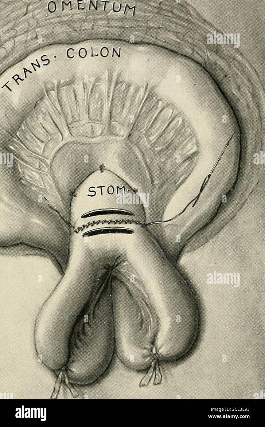 . Chirurgia operativa, per studenti e professionisti . Fig. 14S.-gastrojejunostomia posteriore. Grande omentum e transversecolon sono stati estratti dall'incisione e rivolti verso l'alto. Nel mesocolone trasversale è stata realizzata una apertura per esporre una porzione della parete posteriore dello stomaco. Un anello di jejunum è stato fissato alla parete dello stomaco con un punto continuo, non penetrante e aperture nello stomaco e la bobina attaccata dell'intestino. Il loop di budello è stato bentemporarily legato con nastri. OPERAZIONI SULL'INTESTINO TENUE. 319 selezionato, e questo viene anche fatto uscire Foto Stock