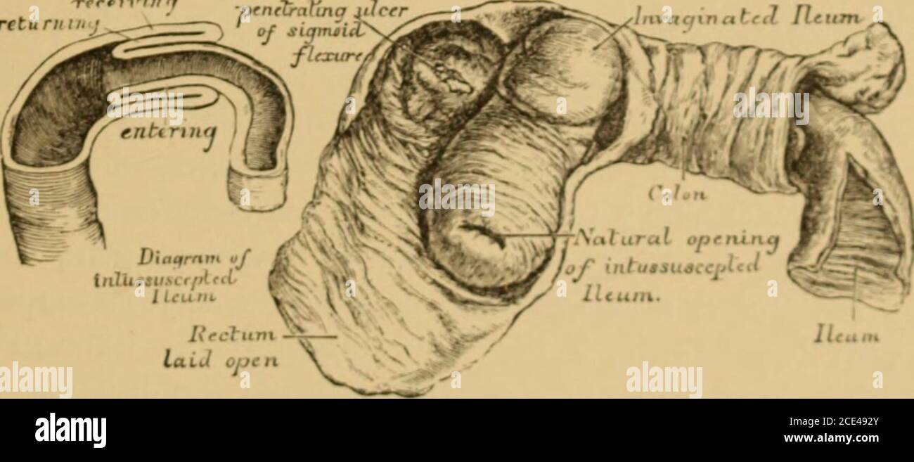 . Un sistema di ostetricia . Uuodtn caso di strangolamento dell'intestino da parte dell'ileo di costrizione della banda linfatica circa Ifrom cecum, e un t-uil di jejunum.1 disteso, l'emaciazione aumenta, e la presenza di una massa dura può essere rilevata attraverso le pareti addominali, Oppure, se l'ostruzione si trova in corrispondenza del teretto, la regione iliaca sinistra può essere riempita con i FiO. 179. FrJ IH. Intussusception, con diagramma che ihowing l'ent in i strangulation del piccolo intestino rnaj essere causato l« peritonea]legamenti falsi, dall'omentum :m Internalhernia, e da torsione, annodamento e compressione i Fig, 178 strangolamento l» ba Foto Stock