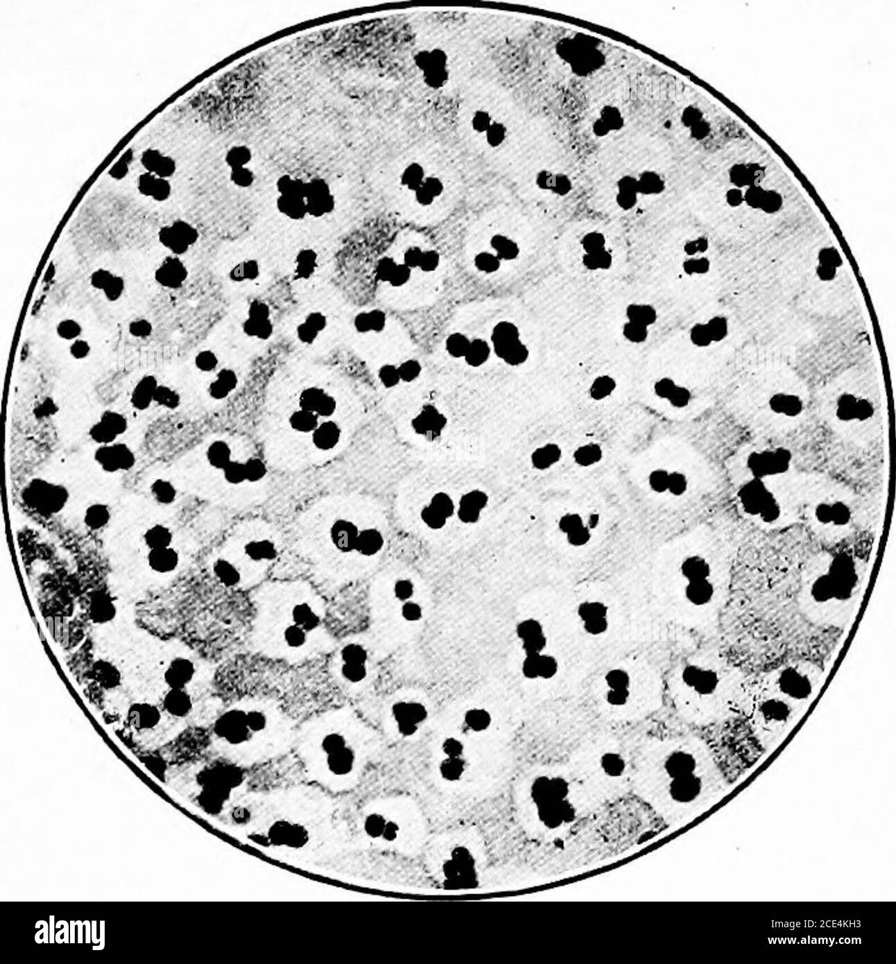 . microörganisms patogena; un manuale pratico per studenti, medici e operatori sanitari . Fig. 100.-Micrococcus tetra-genere. Colorato con blu metilico. X 1000 diametri. Fig. 101.-Micrococcus tetragenus da fluido peritoneo. Colorato con fuchsin. (Frankel.)X 1000 diametri. La sua comparsa occasionale nel pus di ascessi acuti. Il suo presenceè stato notato anche nel pus di empyema a seguito di polmonite. Morfologia.-Micrococci aventi un diametro di circa ix, che dividela due piani, formando tetradi, e legati insieme da una sostanza gelatinosa trasparente, racchiudendo la cellula come a. Foto Stock