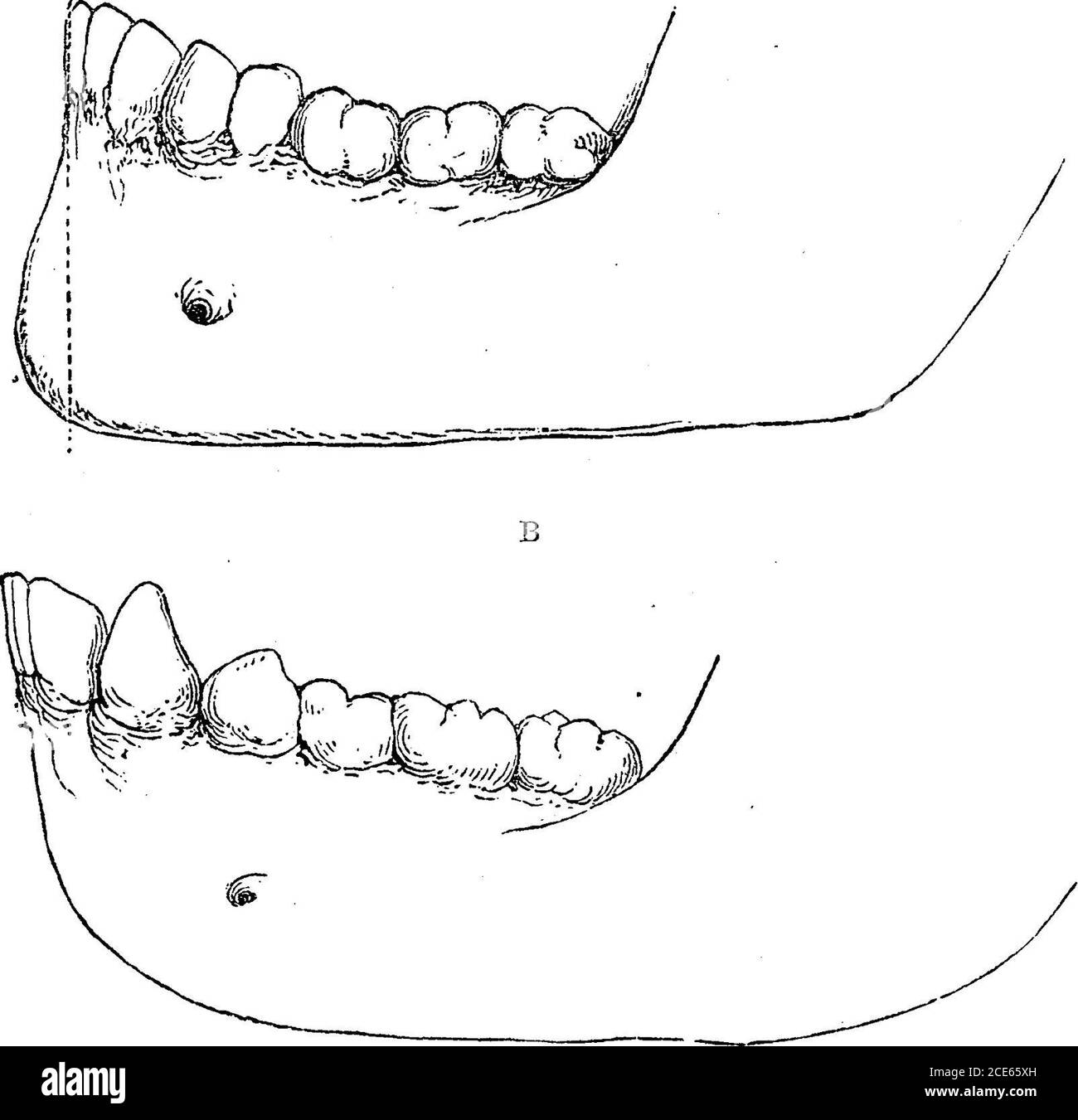 . Antropologia . razze del gruppo umano. L'uomo, almeno il bianco, ha denti verticali; i canini, così come i molari e gli incisivi, sono vicini e più piccoli. I molari permanenti ispiccoli hanno due tubercoli, e i quattro più grandi; in questo rispetto non c'è differenza tra lui e gli antropoidi. Ci sono venti denti temporanei e trentadue denti permanenti, esactlyas nelle quattro scimmie antropoidi, i piteciani, e il numero maggiore dei lemuri. Nei cebiani, un piccolo molare è addodon ogni lato, che aumenta il loro numero totale a trentasei. Alcuni CHAP, i.] CARATTERI FISICI. 59 scimmia Foto Stock