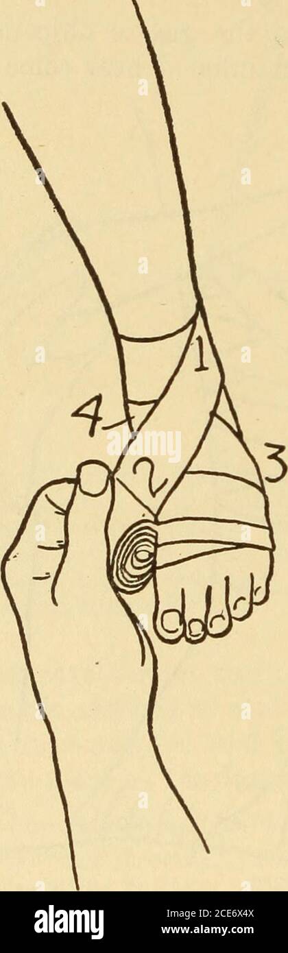 . Dr. Evans' come mantenere bene; . es: Inalazioni di uno spruzzo di acqua di clorina;ossigeno per inalazione; respirazione artificiale dovrebbe essere tenuto su parecchi hoursif necessario. Medicinali per l'emicrania (vedere Acetanilid). Ipoclorito (polvere sbiancante).-Antidoto: Iposolfito di soda,quindici grani in acqua ogni ora per diverse dosi. Iodin.-Antidote: Amido, cucchiaino lavato con acqua. Sali di piombo.-Antidote: Sali di Epsom, cucchiaino in acqua. Eepeat ora inan. Produrre vomito. 890 FIEST AID colic. Di piombo: Ad una pinta di latte bollente aggiungere novanta grani di allume. Givea wineglassful ogni ora o due.Matches Foto Stock