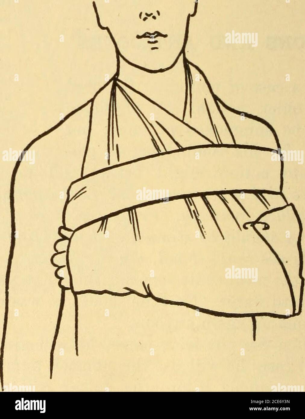 . Dr. Evans' come mantenere bene; . Fig. 353.-TriangularBandage per frattura del collare-osso.. Fig. 354. - condimento per Frattura. Dopo aver ingerito il tubo, l'acqua salata viene versata nell'imbuto. Dopo una buona quantità è stata fatta scorrere nell'imbuto, si abbassano rapidamente VELENI E ANTIDOTI 885 e si sifonano i contenuti dello stomaco. Questo deve essere ripetuto più volte. il %/ Foto Stock