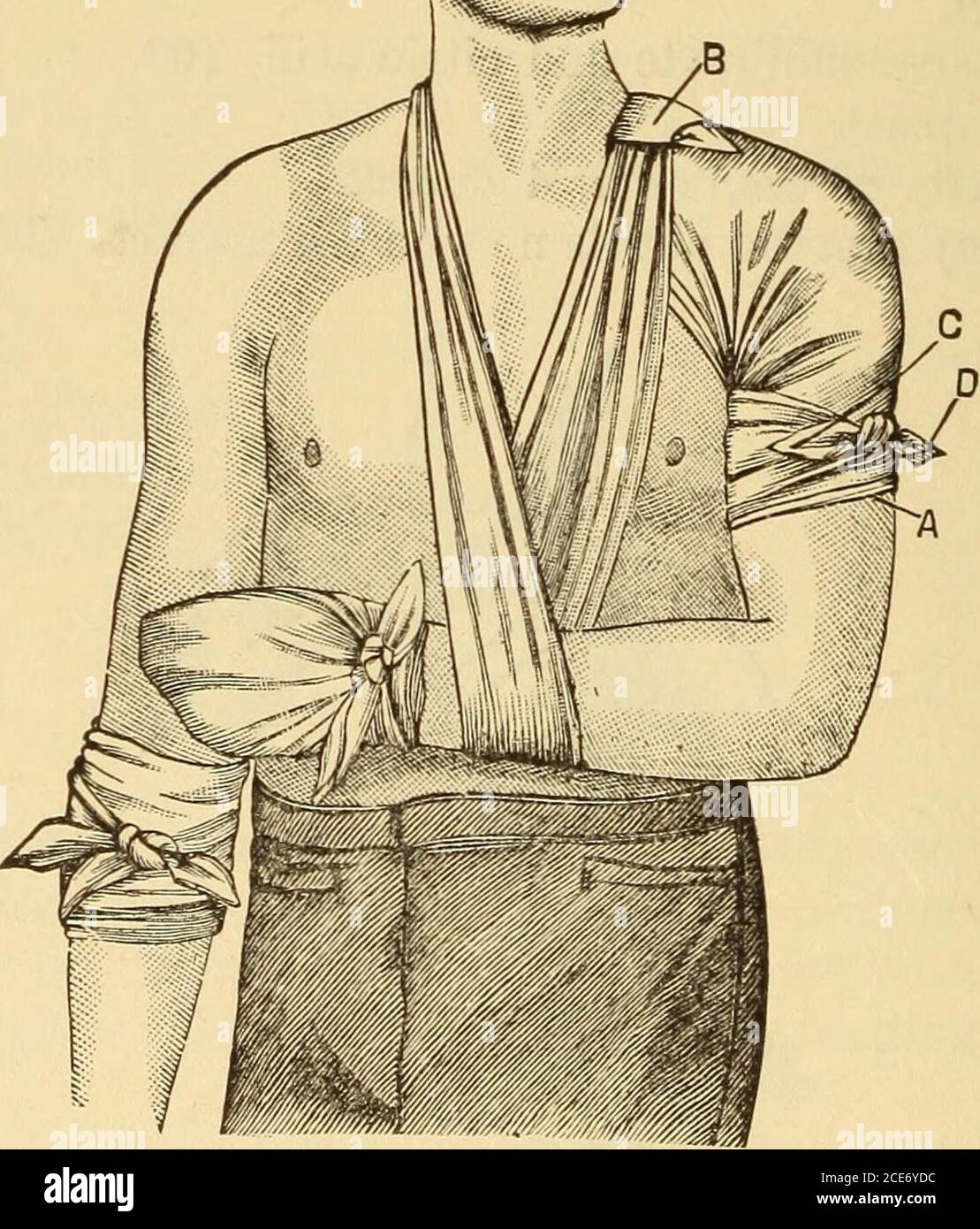 . Dr. Evans' come mantenere bene; . Fig. 349.-gomito di bendaggio.. Fig. 350.-bendaggio triangolare applicato a spalla, mano e gomito. Spalla: Il triangolo deve essere applicato alla spalla posizionando la base A verso il basso a metà del braccio, l'apice B girando verso l'alto contro il collo. I basali C e D sono portati sul lato interno del braccio, incrociati e riportati verso l'esterno e fissati. L'apice B è legato o pinned ad un cravat o un'imbragatura disposta intorno al neck.Hand: Nella ferita alla parte posteriore, o dorsum, la mano può essere bendata posizionandela base del triangolo A verso l'alto a t Foto Stock