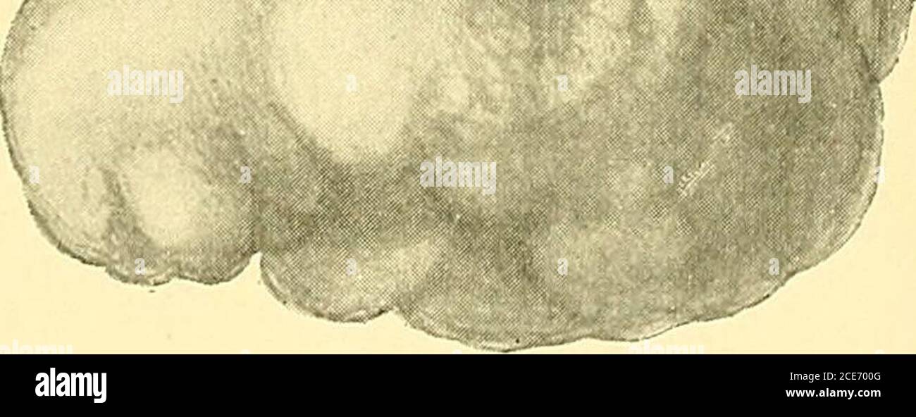 . Alcuni punti nella chirurgia del cervello e delle sue membrane . Fig. I 16. Fig. 117. Fig. 116.-Fotografia del getto di schiena della testa, che mostra la fossa occipitale sinistra rigonfia.(Colman e Ballance.) Fig. 117.-Illustrazione del tubercolo solitario rimosso dalla fossa occipitale sinistra con successo. X Sito di attacco al tentorio. Il paziente aveva 4 anni e 10 mesi. Il tumore misurava 1.82 x 1.73 x 2,2 pollici e pesava l'equilibrio i^ oz. La FIE cade indifferentemente su entrambi i lati.riflesso epigastrico aumentato sul lato destro. Cremas-teric marcato, e uguale. Ginocchiere uguali e non aumentate. Clonu alla caviglia Foto Stock