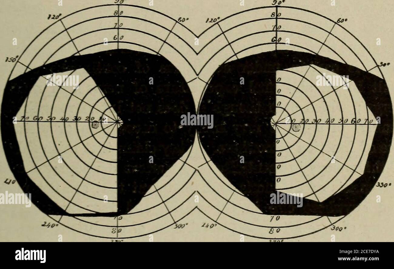 . Rifrazione e motilità dell'occhio, con capitoli sulla cecità cromatica e sul campo visivo . 121, distruggerà le fibre che vanno al lato nasale di ogni occhio efa sì che la metà esterna di ogni campo sia un vuoto. Questa è conosciuta come emianopsia bitemporale. La linea che divide il thenasal dalla metà temporale di ciascuna retina come indicato nei campi di vista è generalmente quasi verticale e passa quasi attraverso il punto di fissazione, Ma poiché la macula è fornita con un fascio speciale di fibre, il punto di fissaggiospesso sfugge, la linea di demarkation ot curvando verso l'esterno circa it.Hemianopsia non ha bisogno di necess Foto Stock