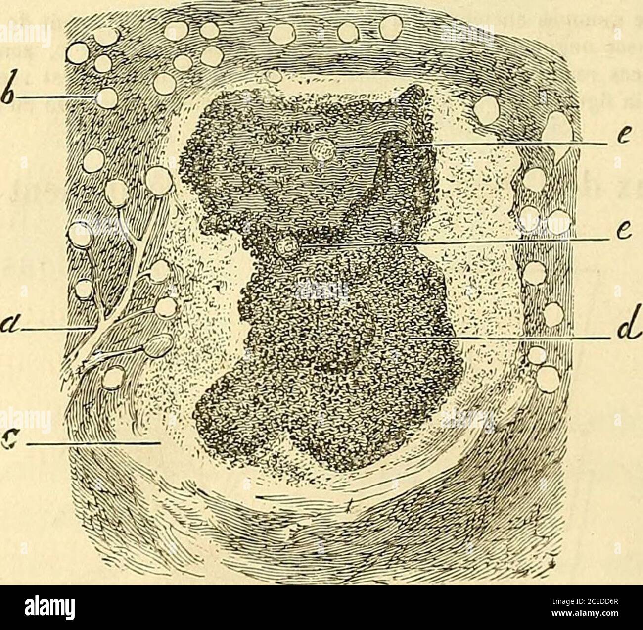 . Manuel d'histologie sperimentale. Fig. 107. mêmes Tissu fiberux formant lenvelpe des gommes en répession : b, espaces renfermantdes cellules et des granulations graisseuses ; c, les   espaces ne contenant que de la graisse. Grossissement de 250 diamètres. Dans la zone fiberuse qui entoure les parties caséeuses, on ren-. FIC. 108. où Gomme ancienne du rein : a, artère et gloniériiles du rein; 6, centre de la gomme reconuaît lo»  encore des glomérules e; d, zone opachi dans laquelle il existe une grande quantité degranulations graisseuses c, fiberux périphérique. Grossissement de 2 Foto Stock