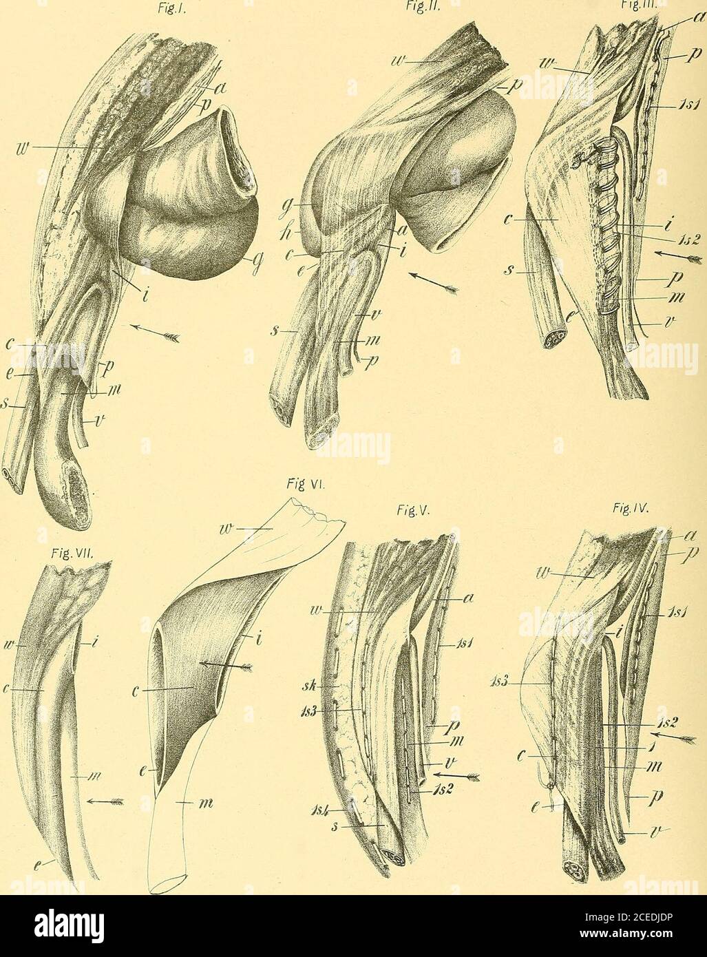 L'anatomia e il trattamento chirurgico di ernia. Fig. 37.-a, anello interno  normale; b,anello interno allargato; c. triangolo non coagulato; d, parete  addominale; h, sac-niale; p. peritonasum; /, riseizzato in corrispondenza  del