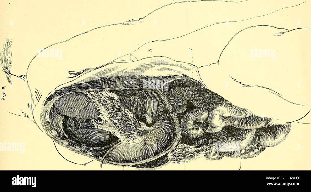. L'anatomia e il trattamento chirurgico dell'ernia ze; solo una piccola porzione del polmone sinistro visibile, che si estenda dalla prima alla seconda costola, e che giace direttamente sulla linea mediana. Le castagne di sinistra erano riempite di stomaco, molto distese di aria. Il consolidamento del polmone sinistro era completo, una parte di esso affondava in acqua. La diagnosi della conditionera evidentemente non stata fatta prima della morte. Due interessanti preparazioni di ferite da sparo del diaframma esistono nel museo di Netley. In entrambi i casi, lo stomaco, il colon, e l'omentum formedthe sporgenze erniali. In uno, la morte Foto Stock