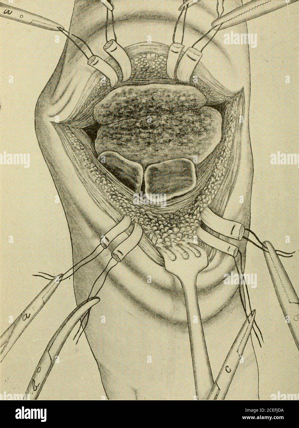 . Un nuovo manuale di chirurgia, civile e militare. Tessuto defunto può essere rimosso. Dopo che questo è stato realizzato, come descritto in relazione al trattamento di articolazioni tuberculose in generale, il piede viene posto in posizione, i tendini accuratamente regolati, che possono essere messi a letto con grande facilità, perché le due suture su due corrispondenti tendini sono fissate a pinze emostatiche dello stesso modello. Ogni tendine è suturato con cura e un punto fine posto nella fascia per coprire la linea di sutura nel tendine. Poi la pelle è suturata su tutto. Se il drenaggio sembra necessario, è applicato attraverso un Foto Stock