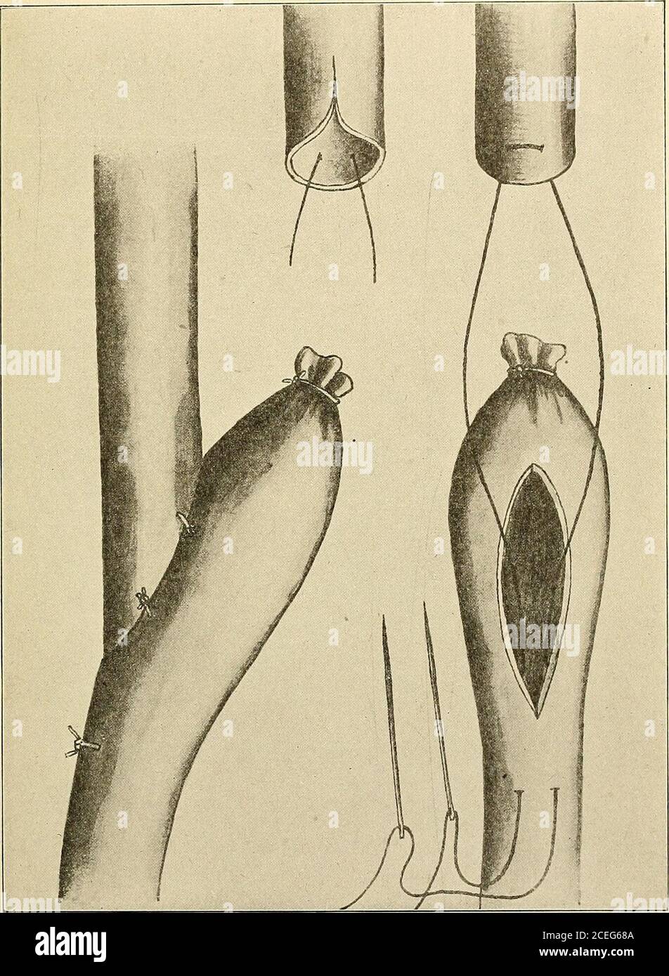 . Un nuovo manuale di chirurgia, civile e militare. Curato con alcuni punti di catgut veryfine al lato dell'uretere e il peritoneo è chiuso nel complesso. Viene inserito un catetere di ritenzione e al paziente viene fornita mezzo pinta di acqua distillata con cinque gocce di acido solforico aromatico diluito ogni due ore. Un tubo di drenaggio in gomma morbida e diversi scarichi di sigaretta vengono fatti passare verso il basso fino al punto di anastomosi e fuori dall'angolo inferiore della ferita. Sono rimasti in posizione quattro giorni a meno che non si verifichi una perdita, nel qual caso sono rimasti dieci giorni, a meno che la perdita non si spartisca prima. Il catetere viene lasciato all'interno Foto Stock