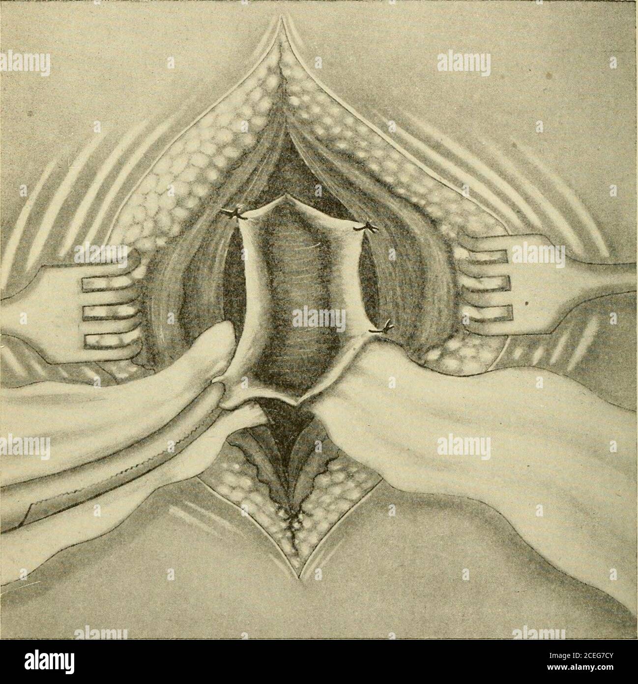 . Un nuovo manuale di chirurgia, civile e militare. Pelvi del rene, e la sospensione del kidneyin sua posizione normale, secondo il metodo appena delineato, eviterà in futuro l'ostruzione all'uretere; di conseguenza, si può prevedere un recupero permanente a meno che l'ulcerazione non sia dovuta alla distorsione del furetere, e questo a sua volta ha prodotto una costrizione cicatriziale che forma una fibroustrizione. Il grado di costrizione determinerà la forma di trattamento in questi casi. Se la costrizione è solo moderata, semplice drenaggio della CHIRURGIA 560 DEL TRATTO GENITO-URINARIO idronepr Foto Stock