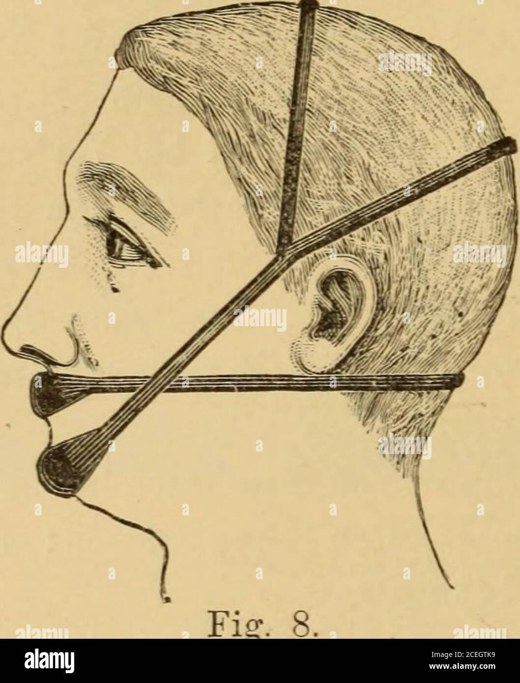 . iese einfache Vorrichtung da, wo die Xasenathmungmöglich, aber noch nicht eingeübi ist. Es genügt auch, Dach dem Vorschlag von Löwenberg (14und zahnlose Greise haben es wohl schon früher 30 gehalten - einfach 304 Dr. E- Blocl1 durch eine Kinnbinde den Unterkiefer an die oberen Zähne anzudrängen,um dauernd den Mund zu schliessen. Die Vortheile beider Vorrichtungen mit einander verbindend hatVohsen (38) seinen Anoralresfirator angefertigt, welcher aus einer Mund-platte und einer Kinnstütze mit Gummidichtungen besteht, die vereinigtan dem Kopfe befes Foto Stock