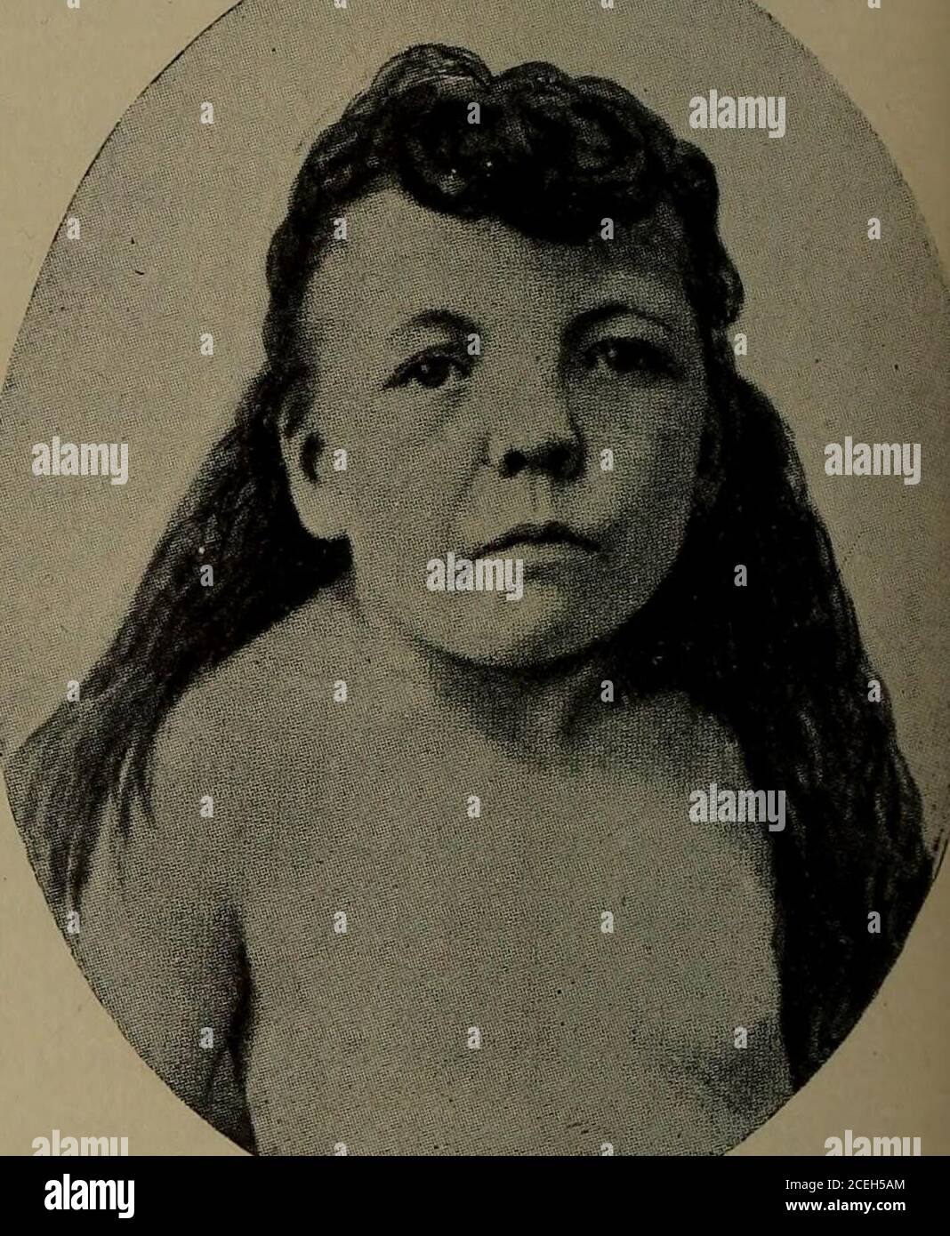 . Malattie mediche dell'infanzia e dell'infanzia. Il cretinismo acquisito, a, si afferma che il paziente si è sviluppato normalmente fino all'età di 5 anni, quando ha avuto un grave attacco di scarlatto, dopo il quale la crescita quasi cessata, e un grande changecame sul suo stato mentale. All'età di 18% anni, quando la fotografia è stata presa per me da Dr. George W. B. Waters, era infantile, non mostrava segni di pubertà, ed era lenta nel movimento e nel discorso. La sua altezza era 44 pollici e il suo peso 48 libbre l'altezza media di agirl di 18 anni è 62.5 pollici, e il peso medio 117.7 libbre l'hei medio Foto Stock
