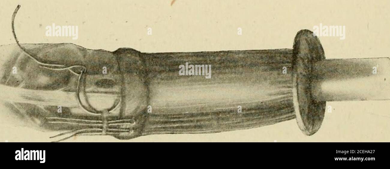 . Un nuovo manuale di chirurgia, civile e militare. 2. Mostrando tubo usato per portare le due estremità in posizione, e prima Eow op suture posto. Rimosso, durante il periodo di recumbency dopo l'operazione, thedilatation dello stomaco di solito scompare più o meno completamente. In diverse occasioni dopo un intervallo variabile dall'operazione di resezione dell'intestino crasso, la dilatazione dello stomaco è diventata una caratteristica di sufficiente. 3. Mostrando intussuscezione compiuta ed Eow esterno di suture ha messo. Importanza per richiedere il relativo drenaggio più efficace da un gastro-enterostomy.This Foto Stock