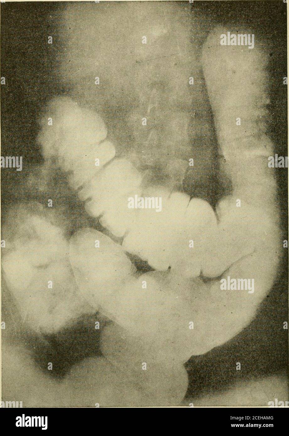 . Un nuovo manuale di chirurgia, civile e militare. Operazione fob l'eliminazione del Colon Ascendente, trasversale e discendente per la credenza della stasi intestinale. L'ileo è stato tagliato 10 cm. Dal cecum e l'estremità cecale è passata attraverso un'incisione di aMeBurney, facendo a questo punto una colostomia permanente. Anche la sigmoide è stata bestemmiata e la fine del colon discendente è passata attraverso una simile incisione MeBurney sul lato sinistro. Un'anastomosi end-to-end è stata poi realizzata tra l'estremità prossimale dell'ileo e l'estremità distale del sigmoide, e un tubo di drenaggio rettale è passato fino all'ileo. Foto Stock