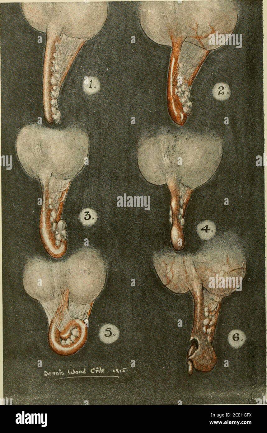 . Un nuovo manuale di chirurgia, civile e militare, contiene spesso concrezioni fecali. I pazienti che soffrono di questa condizionisolitamente hanno attacchi ricorrenti frequentemente che non raramente terminano nella perforazione. Fig. 10 rappresenta una breve appendice a parete spessa con una concrezione fecale alloggiata in zona anulcerata con gangrene iniziale della mucosa circostante. Questo appen-dix è ampiamente aperto alla sua estremità cecale, rendendo possibile il drenaggio continuo nel cecum. Fig. 11 rappresenta un'appendice con parete similmente ispessita. Un'area ulcerata è pris-ent vicino alla sua estremità distale, contenente muco Foto Stock
