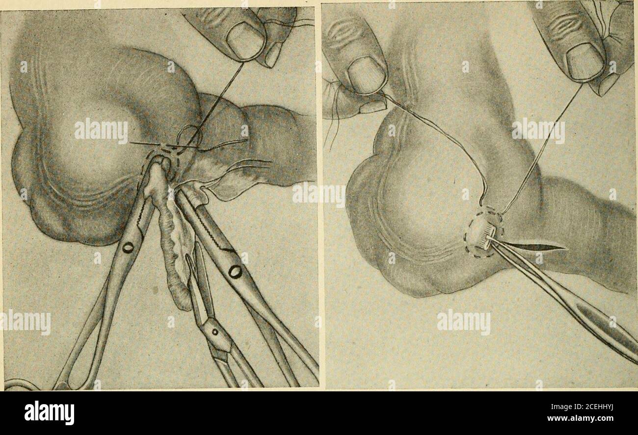 . Un nuovo manuale di chirurgia, civile e militare. Allof l'appendice. Il lume a questo punto è così piccolo che basterebbe un leggero edemaper chiuderlo completamente, e con questa chiusura scomparirebbe ildrenaggio della cavità dell'appendice. Il materiale settico presente in thislumen aumenterebbe, naturalmente, molto rapidamente così non appena il drenaggio fosse scomparso in modo com-pletely, e questo porterebbe ad un attacco ricorrente. I disturbi digestivi con cui un tale paziente è afflitto possono essere spiegati, in primo luogo, dall'interferenza con la circolazione fecale a causa delle estese adesioni che attirano l'i. Foto Stock